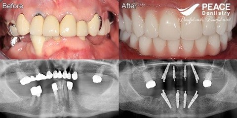 trồng răng implant all on 4 cho trường hợp đeo hàm tháo lắp