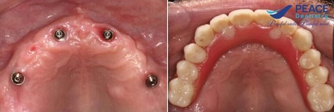 trồng răng implant all on 4 với trụ dentium