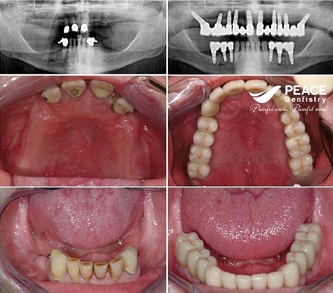 trồng răng all on 6 cho răng mất lâu năm