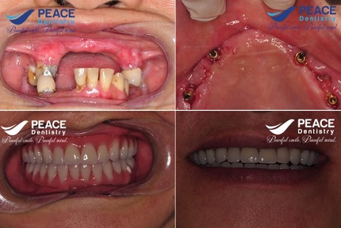 trồng răng implant all on 4 ăn nhai khỏe