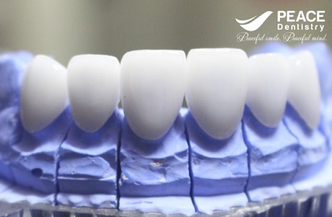 các loại răng sứ tại peace dentistry