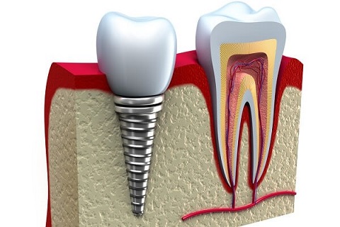 tuổi thọ của răng implant