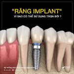 tuổi thọ của răng implant