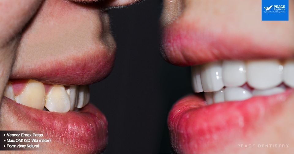 công nghệ chế tác cad/cam giúp răng sứ đẹp tự nhiên