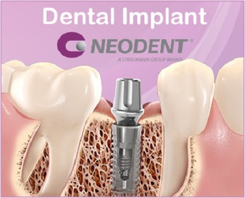 trụ implant neodent straumaan