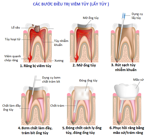 quy trình lấy tủy tại peace dentistry