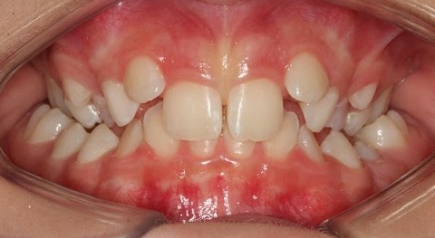 niềng răng cho răng mọc lệch