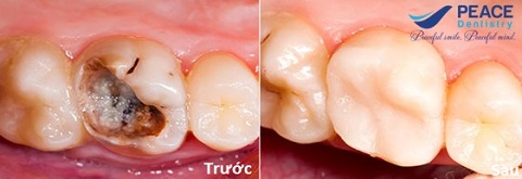 chữa tủy cho răng hàm sâu