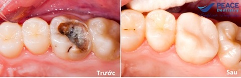 điều trị tủy và phục hình răng sứ