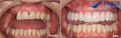 trồng răng sứ cho răng hàm