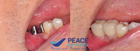 trồng implant răng hàm