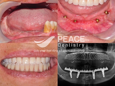 trồng răng implant all on 4 hàm dưới