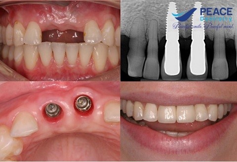cấy 2 implant răng cửa
