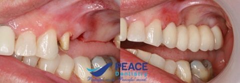 trồng sứ bắc cầu cho răng hàm