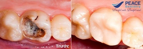 chữa tủy răng hàm bị sâu viêm tủy