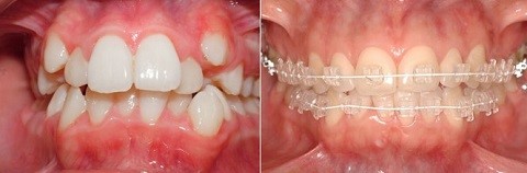 trước và sau niềng răng