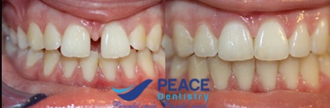 hình ảnh trước và sau niềng răng