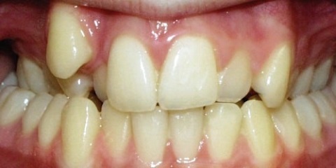 răng mọc khểnh có nên nhổ không