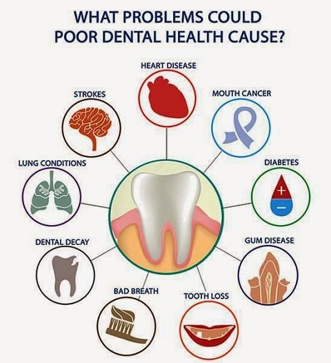 sâu răng ảnh hưởng đến sức khỏe cơ thể