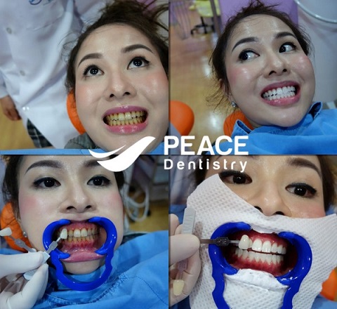 tẩy trắng tại peace dentistry