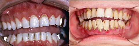 vôi răng gây mất thẩm mỹ