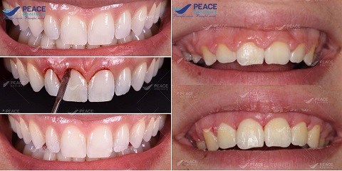 cắt nướu làm dài thân răng peace dentistry