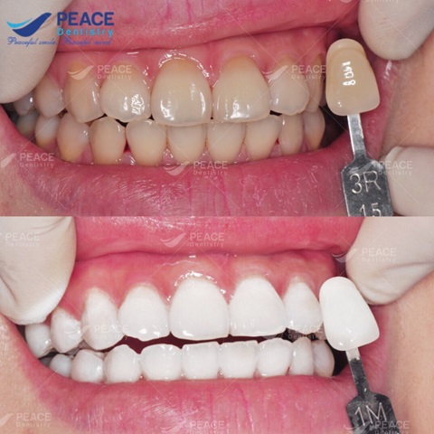 hình ảnh khách tẩy trắng tại peace dentistry