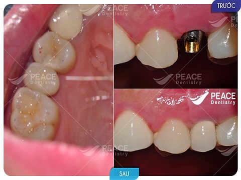 hình ảnh khách hàng trồng răng implant