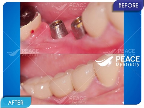 hình ảnh khách hàng cấy ghép implant tại peace dentistry