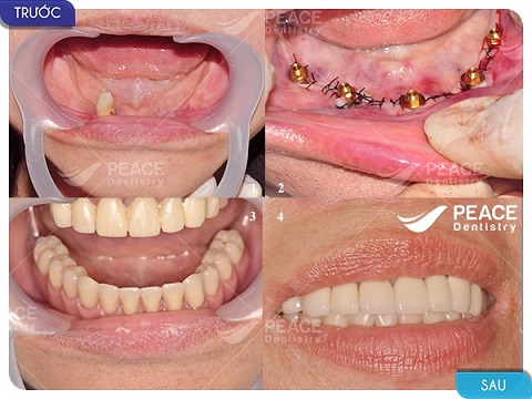 hình ảnh khách hàng trồng răng implant tại peace dentistry