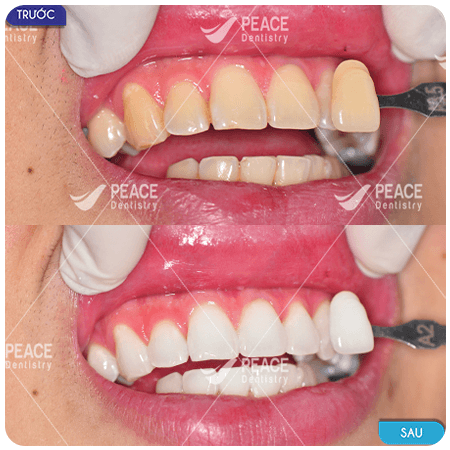 hình ảnh khách hàng tẩy trắng răng tại peace dentistry