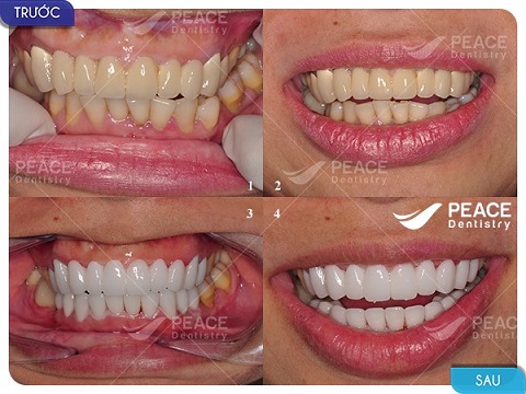 bọc răng sứ nguyên hàm cho răng mọc lệch
