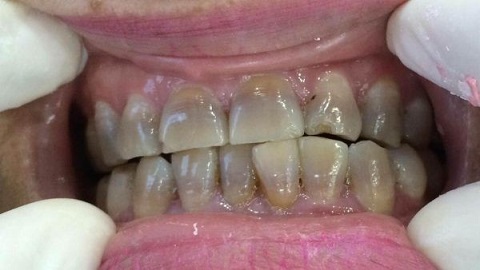 răng bị nhiễm kháng sinh nặng cho dùng nhiều tetra