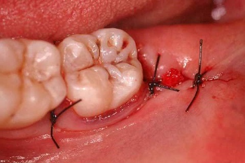 tiểu phẫu răng khôn