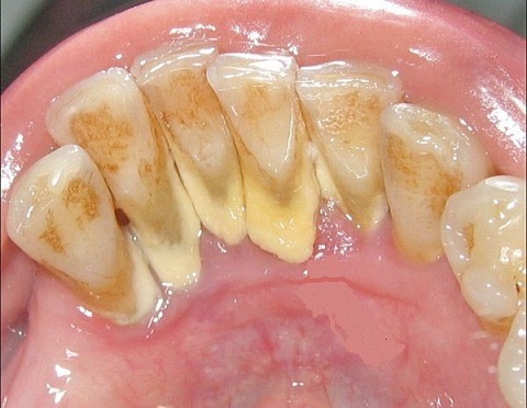 vôi răng là nguyên nhân của bệnh nha chu