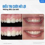 điều trị cười hở lợi