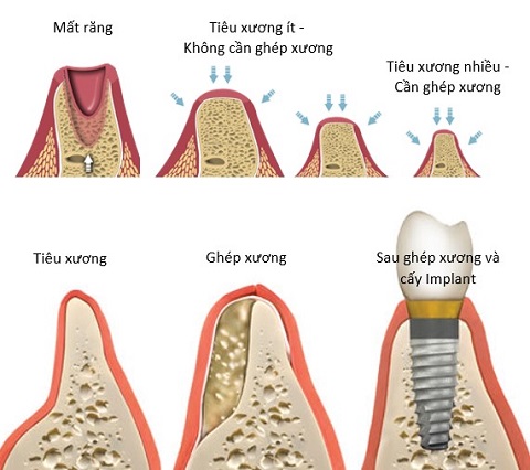 trồng răng implant cho trường hợp tiêu xương nhiều