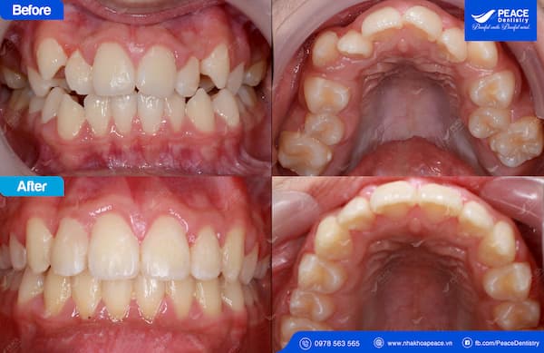 niềng răng mọc lệch invisalign hoàn thành sau 24 tháng