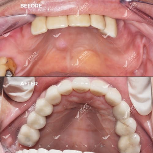trồng răng implant cho trường hợp tiêu xương