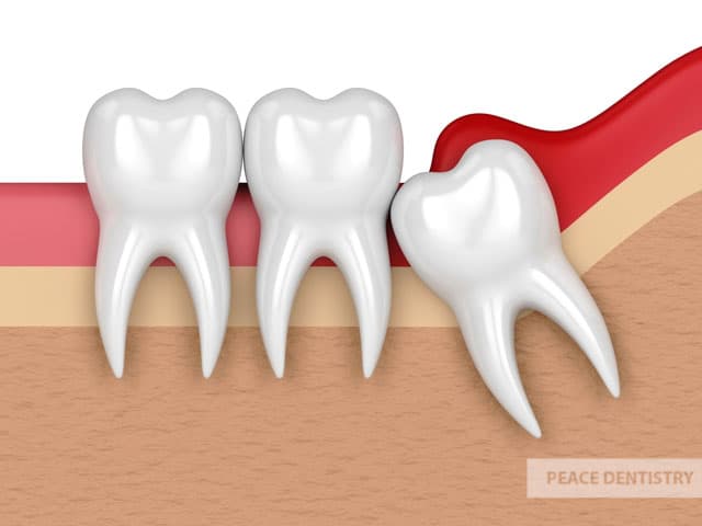 phân biệt răng cấm và răng khôn
