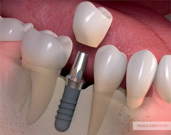trồng răng cấm bằng phương pháp cấy ghép implant