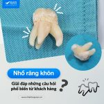 nhổ răng khôn giải đáp những câu hỏi phổ biến