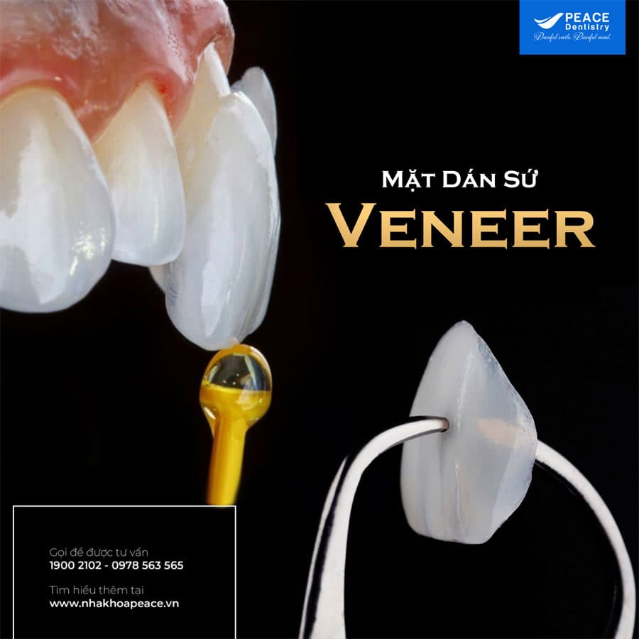 Dán Sứ Veneer - Nha Khoa Peace Dentistry Uy Tín TpHCM
