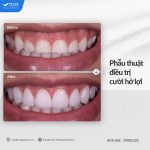 phẫu thuật điều trị cười hở lợi