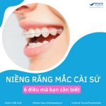 niềng răng mắc cài sứ 6 điều cần biết