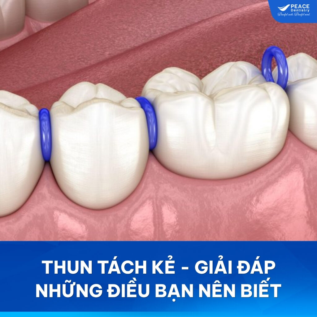 thun tách kẽ răng