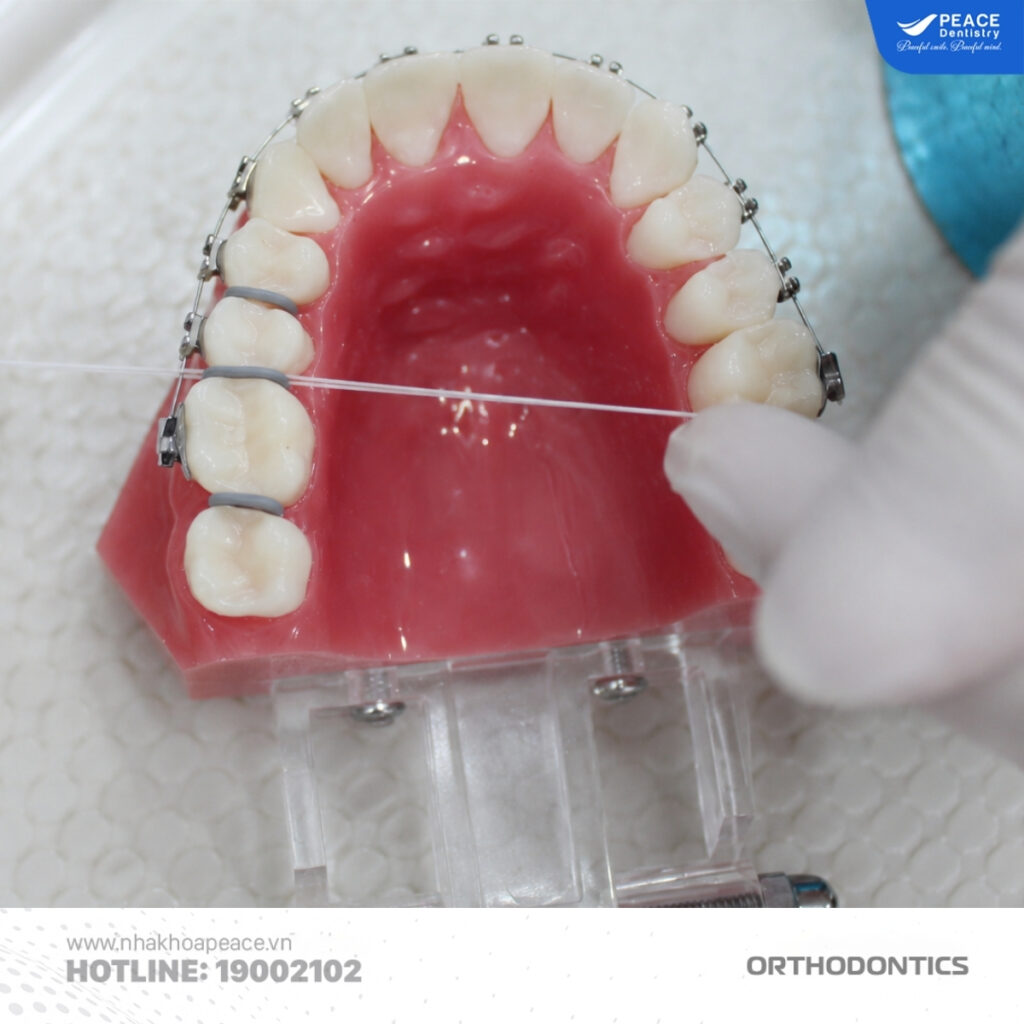 đặt thun tách kẽ khi niềng răng