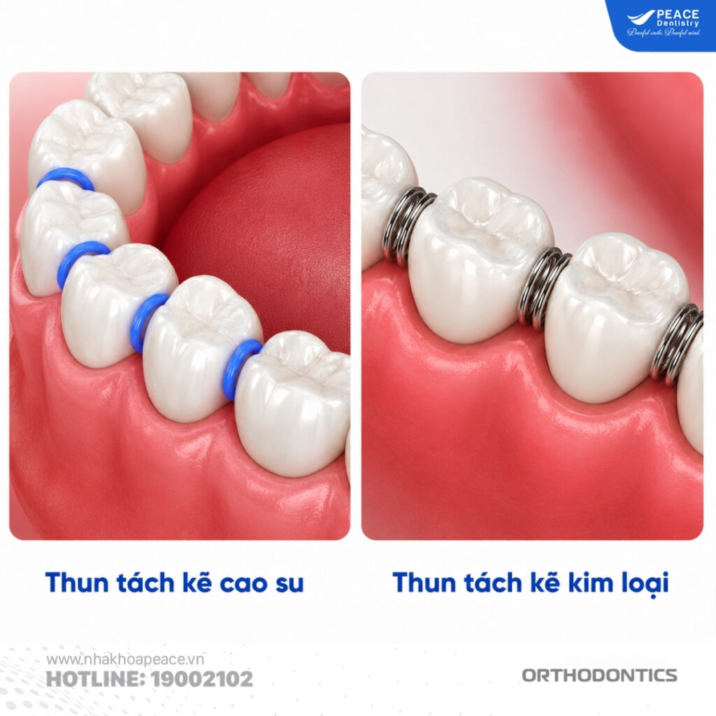 thun tách kẻ cao su và thun tách kẻ kim loại