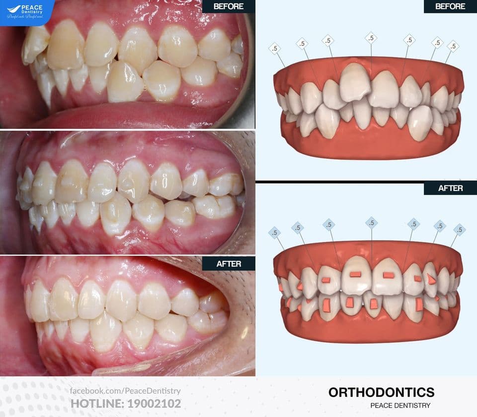 niềng răng trong suốt cho răng chen chúc nặng không nhổ răng