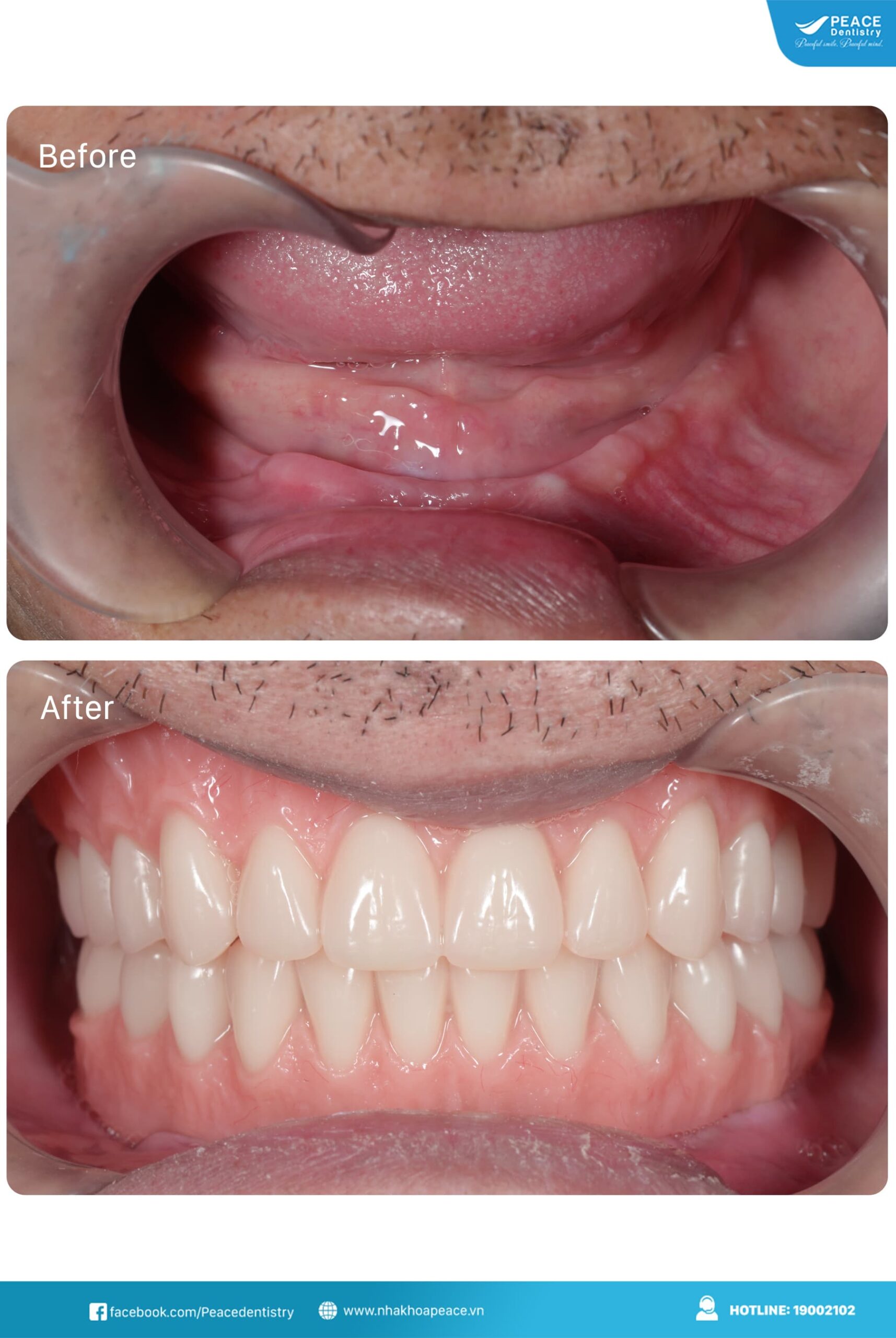 trước và sau khi điều trị với kế hoạch all on 4 implant hàm dưới và hàm tháo lắp hàm trên